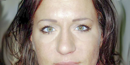 Woman with under eye puffiness