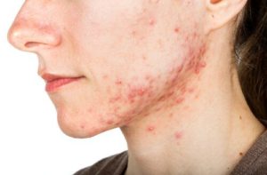 Benefits of Chemical Peels for Acne