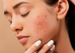 The Seven Deadly Sins of Bad Acne