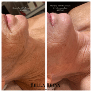 Bella Reina Spa HIFU Facial Before & after