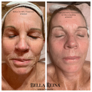 Bella Reina Spa HIFU Facial Treatment Before & After