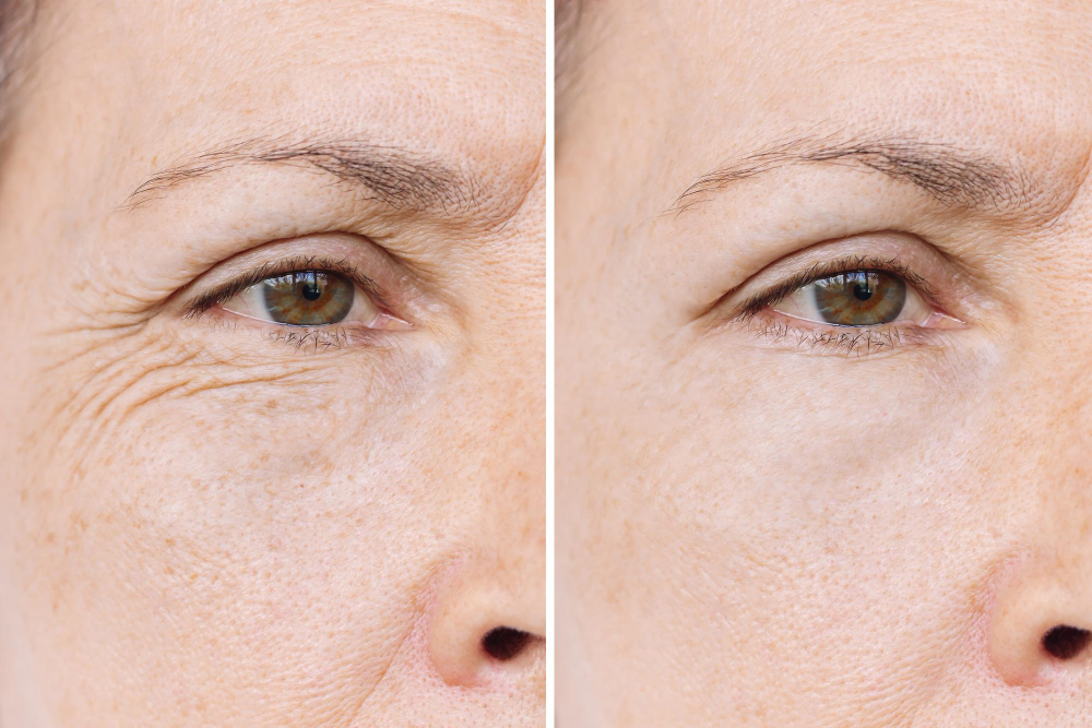 Micro-needling addresses issues like fine lines, scars, and enlarged pores