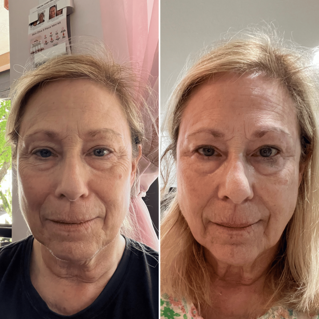 Before and After Exosome Microneedling and Skin Diva Products