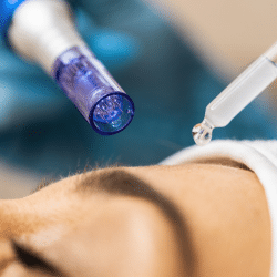 Peptide Microneedling